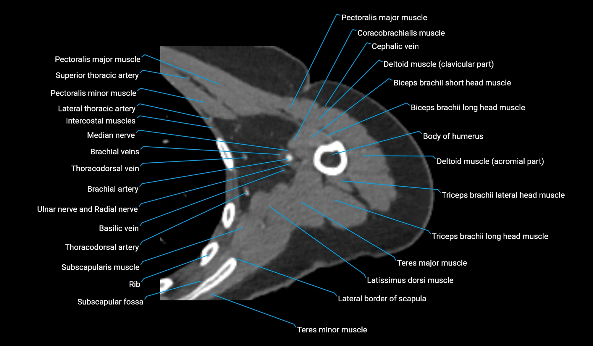 CT upper arm axial  cross sectional anatomy labelled radiology image -00154.webp